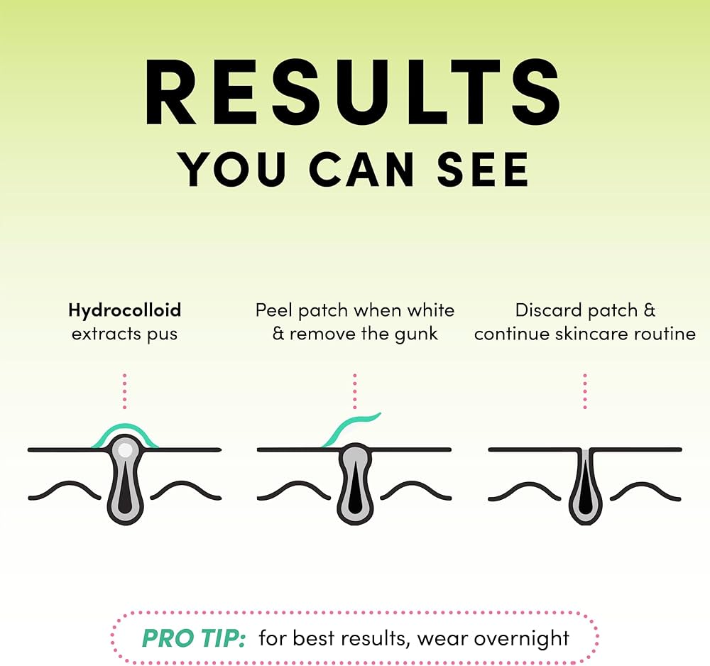 PoreClean - Akneplåster med Hydrokolloid för Frisk Hud på En Natt