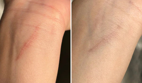 Luviva - Kehittynyt Silikoniteippi Arpien ja Ryppyjen Hoitoon