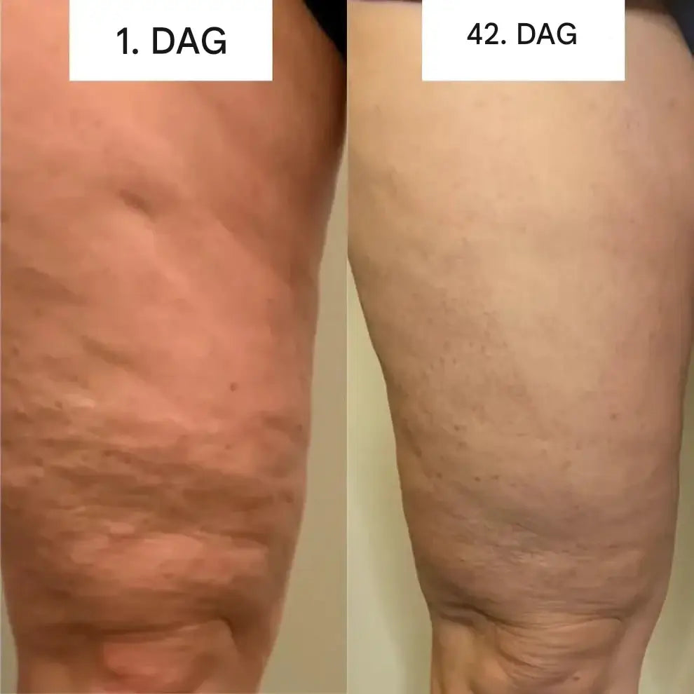 GlowCup - Selluliitin poisto ja ihon kiristäminen punaisella valolla ja kuppausterapialla