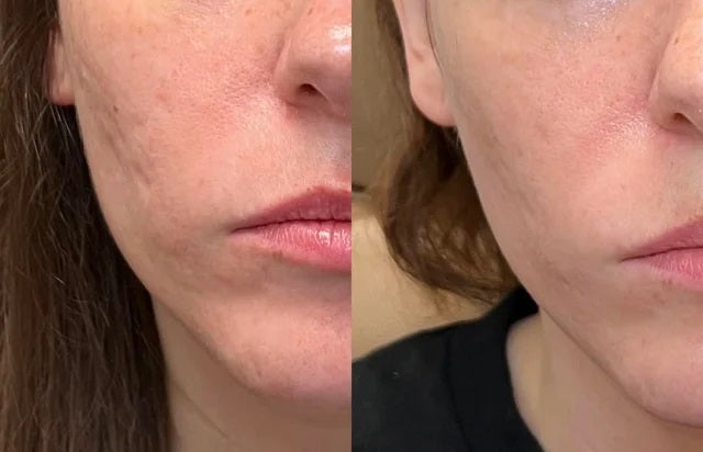 Luviva - Kehittynyt Silikoniteippi Arpien ja Ryppyjen Hoitoon